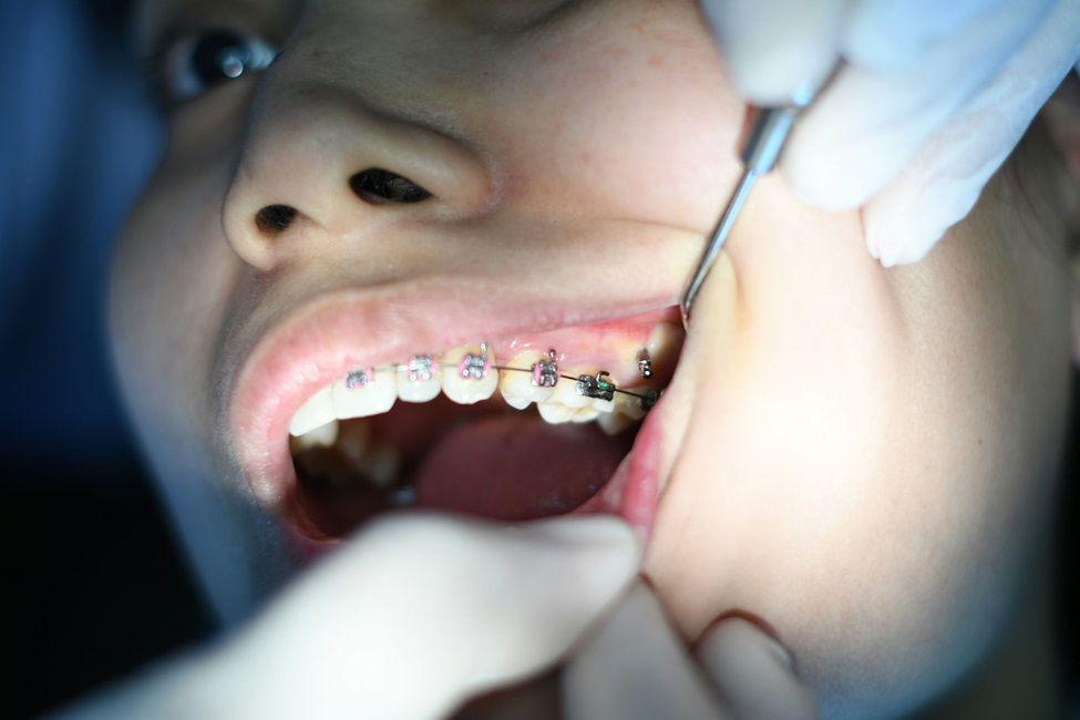 Life with Braces & What to Expect During Your Orthodontic Journey