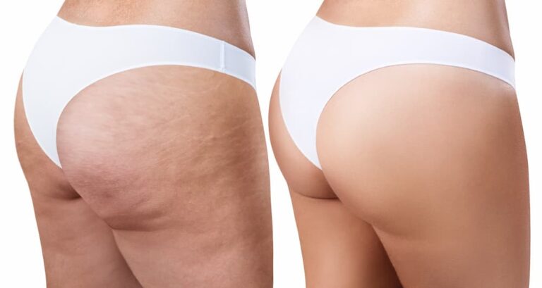 What Can You Expect During and After Cellulite Injection Treatments?